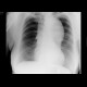 Dissecting aneurysm of the thoracic aorta, thrombosis of false lumen: X-ray - Plain radiograph
